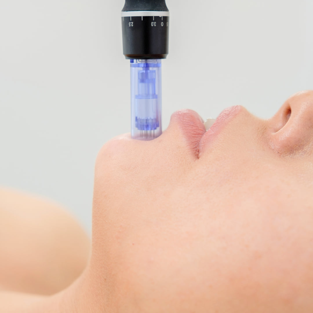 Microneedling în cabinet cosmetic