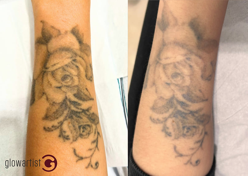 Tatuajele colorate și negre - realizare și eliminare