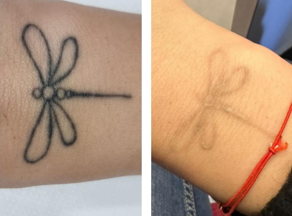 Îndepărtare a tatuajelor folosind laserul Q-switched