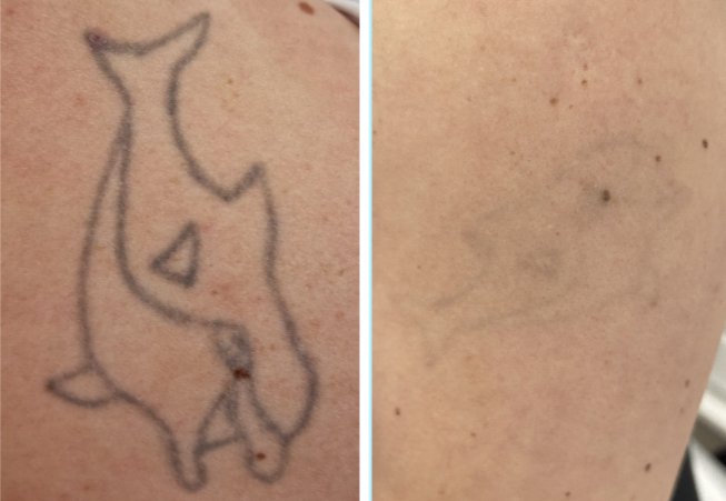 Îndepărtare a tatuajelor folosind laserul Q-switched
